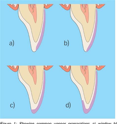 Veneer Prep Diagram