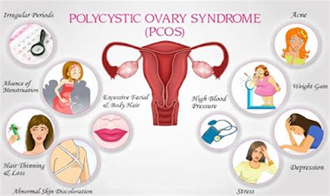 Gynecologist in Gurgaon - Dr. Ragini Agrawal: PCOS Treatment Options at Gurgaon - Know the ...