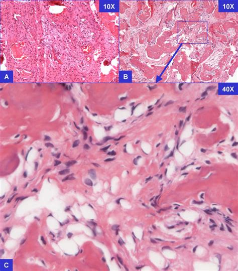 Fibrous Dysplasia With Collagenized Stroma The Cells In The Stroma Are