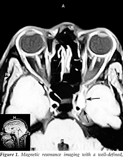 Figure 1 From Alternating Orbital Symptoms In Cavernous Sinus Syndrome Due To Isolated Sphenoid