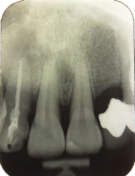 Periapical X Ray Of Tooth 12 After 6 Months Download Scientific Diagram