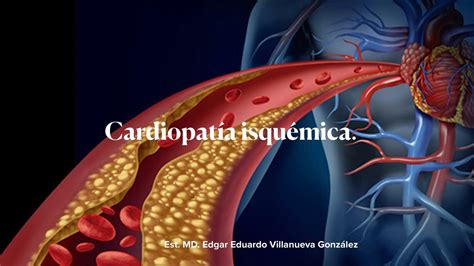 Cardiopatía isquémica Dr Villanueva uDocz