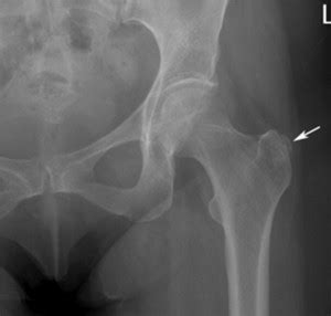 Greater Trochanteric Pain Syndrome Diagnosis and Treatment | Musculoskeletal Key