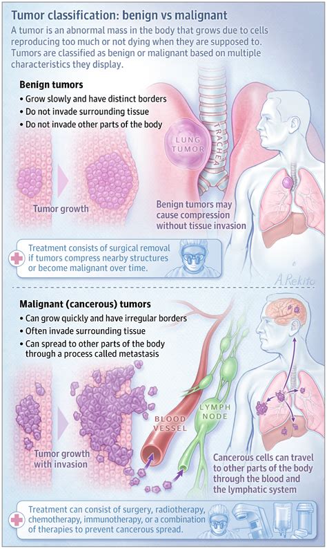 Benign Vs Malignant Tumors Oncology Jama Oncology Jama Network