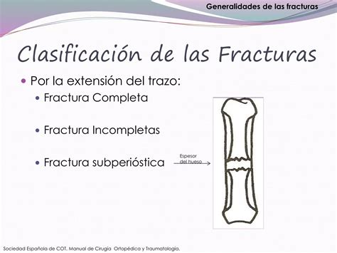 Generalidades De Las Fracturas Ppt