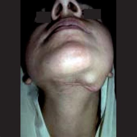 Extraoral Clinical Photograph Showing Swelling In Left Submandibular