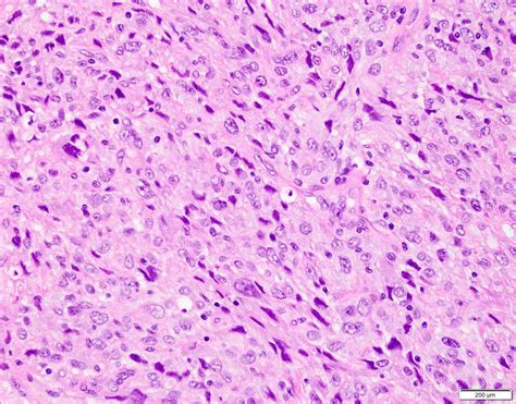 Atypical Fibroxanthoma Histology