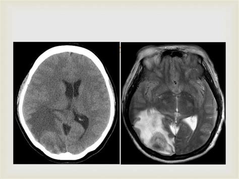 Neuro Radiology Neuroimaging Ppt