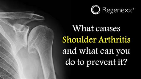 What Causes Shoulder Arthritis? - Regenexx®