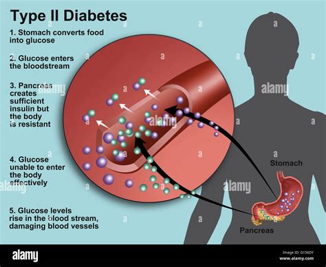 Llustration producción de insulina y glucosa en la diabetes tipo 2 La