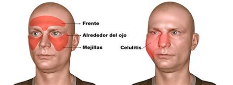 Celulitis Facial