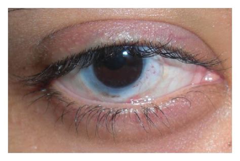 Patient With Total Limbal Stem Cell Deficiency After Chemical Burn Who