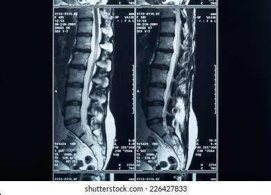 2,655 Broken Spine Xray Images, Stock Photos & Vectors | Shutterstock