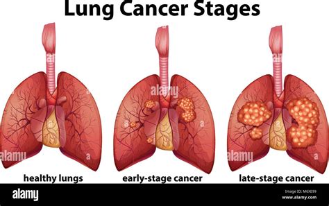 Lung Cancer Drawing Drawing Rjuuc Edu Np