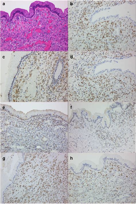 Mucinous Cystic Neoplasms Mcns Harboring Ovarian Type Stroma A