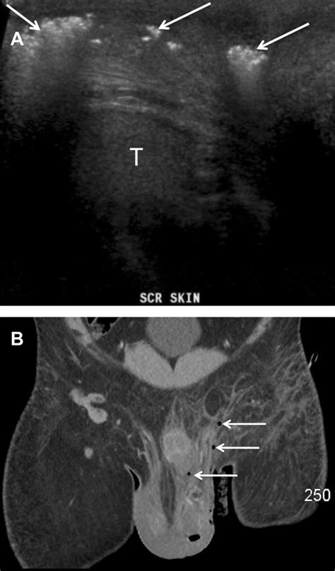 Sonography Of Scrotal Wall Lesions And Correlation With Other