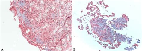 Histological Sections Of Gastric Mucosa A And Duodenal Bulb B At 10X