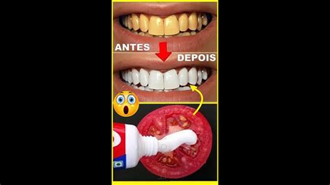 Como Clarear Os Dentes Em Casa Receita Caseira Em 2 Minutos