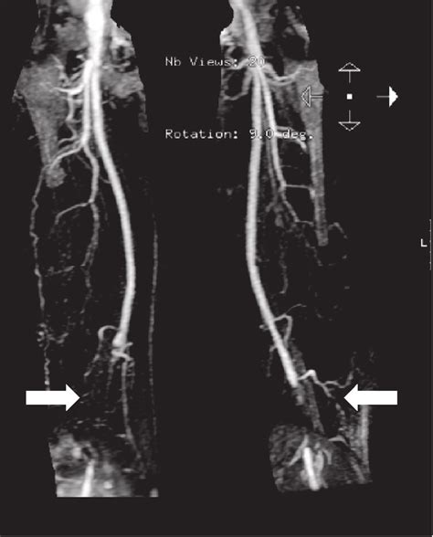 Contrast-enhanced magnetic resonance angiography (MRA) of lower limbs ...