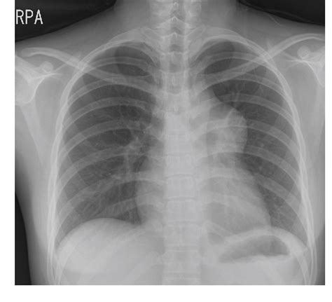 Figure From Benign Mature Teratoma In Anterior Mediastinum Semantic