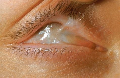 Lime Burn To Eye Stock Image C0365796 Science Photo Library