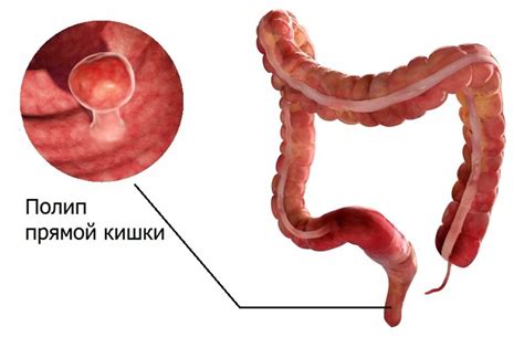 Как лечить полипы в прямой кишке: советы и рекомендации
