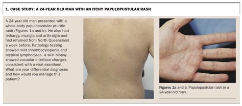 Unilateral Laterothoracic Exanthem Treatment