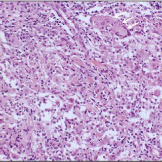 Microscopic Findings Of Peritoneum Multinucleated Giant Cell Arrows