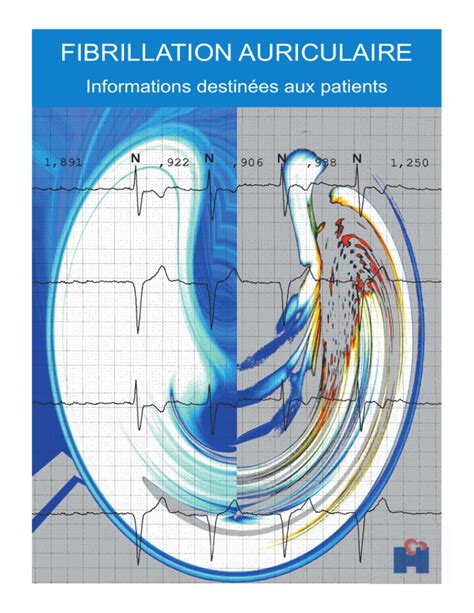 FIBRILLATION AURICULAIRE