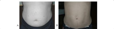 A, B: A Postoperative scars in a 12-year-old boy, 1 month after ...