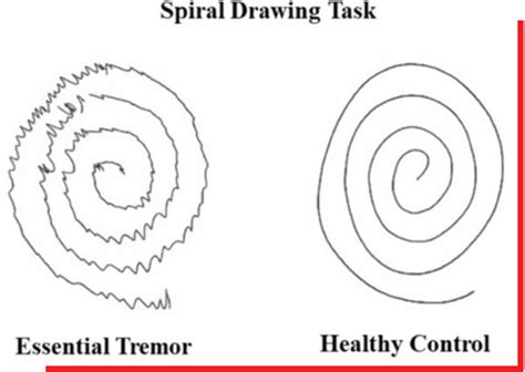Essential Tremor Cell Tissue Technology