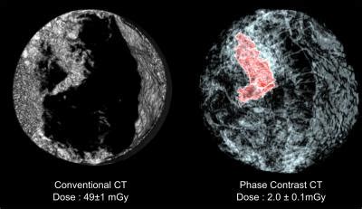 New X-ray breast cancer imaging possible with 25 times reduced radiation dose