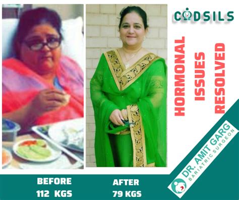 Bariatric Surgery Results Success Stories Dr Amit Garg