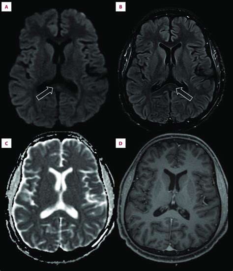 Brain Magnetic Resonance Imaging Mri On Admission Diffusion Weighted Download Scientific