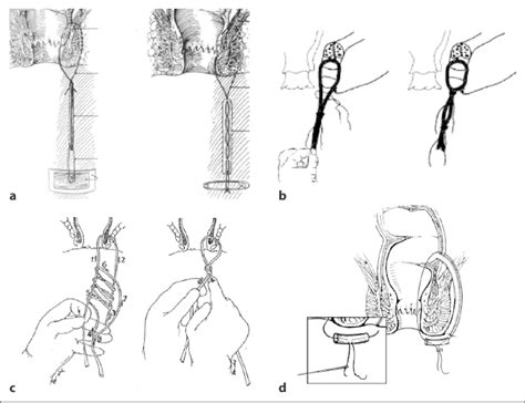 Setons In The Treatment Of Anal Fistula Review Of Variations In