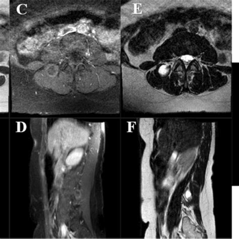 Pre Operative Axial And Sagittal Mri Images Demonstrating A Right Sided Download Scientific