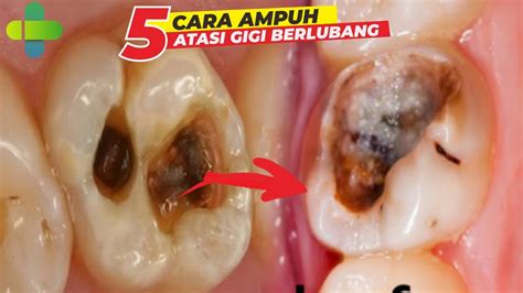 Cara Mengatasi Agar Gigi Berlubang Tidak Sakit