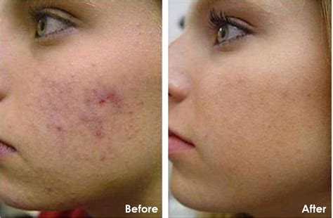 Chemical Peels Beverly Hills Los Angeles La Skinaesthetics