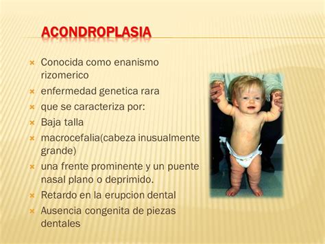 Acondroplasia Definicion Pdf