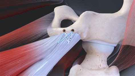 Arthrex Proximal Hamstring Repair