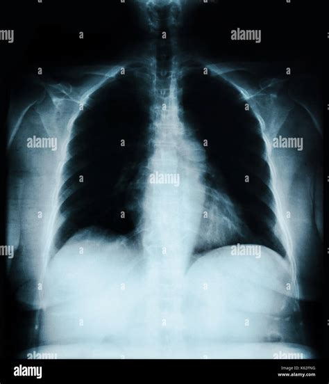 X Ray Lung Image On Black Stock Photo Alamy