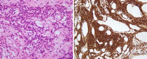 Figure5pathological Findings Of Resected Specimens Of The Tracheal