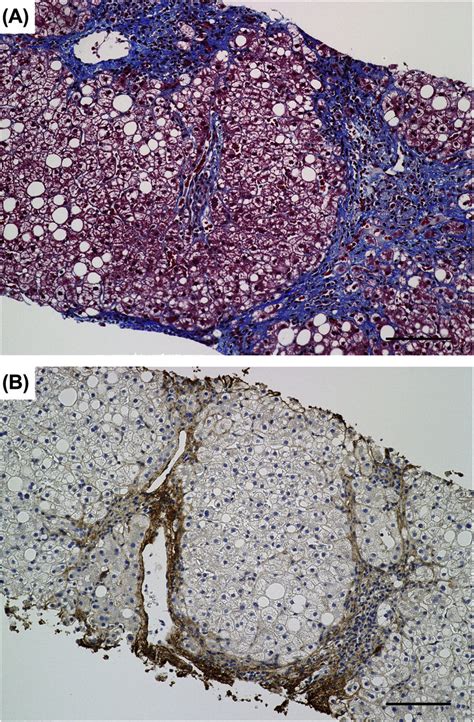 The Evaluation Of Liver Fibrosis By Masson S Trichrome Staining And