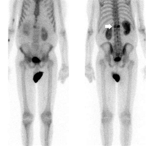 Whole Body Bs Anterior A And Posterior B Views Performed Days