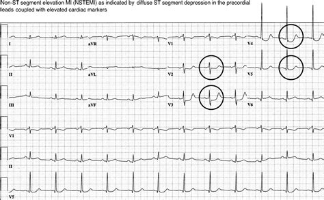 Ischemia And Infarction Ecg In 10 Days 2e Accesscardiology