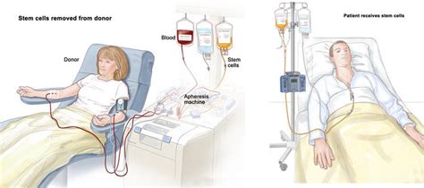 Stem Cell Transplant A Revolutionary Treatment Option