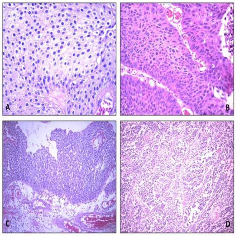 Transitional Cell Carcinoma Of The Urinary Bladder A Intermediate Download Scientific Diagram