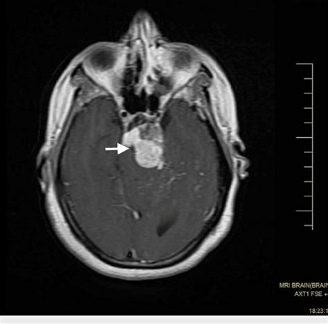 Figure 1 From Magnetic Resonance Imaging Findings In A Rare Case Of A