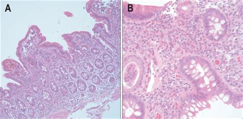 Duodenal Biopsy Histology A Eosinophilic Infiltration With Mixed