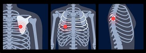 Menschlicher Schmerz Bruch Oder Entz Ndung Im Brustkorb Anatomische